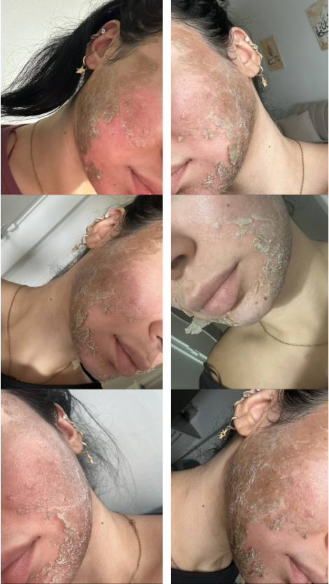 Acné visage : avant et après le protocole