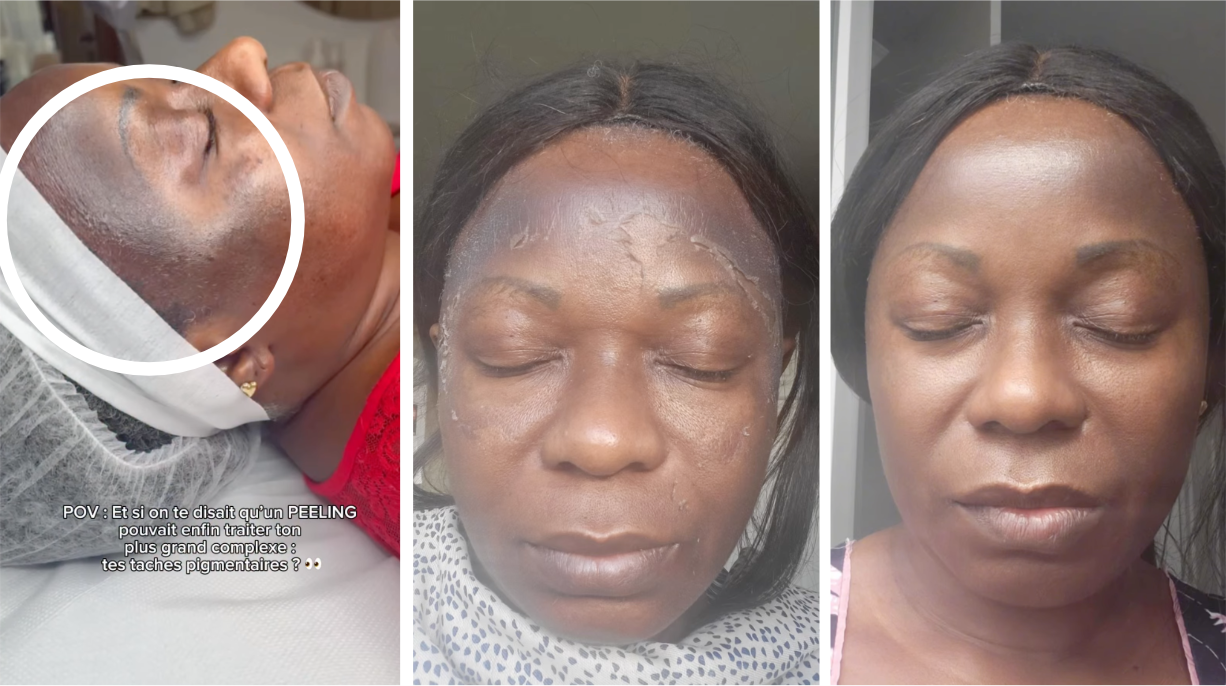 Taches pigmentaires visage : début, pendant et après le protocole