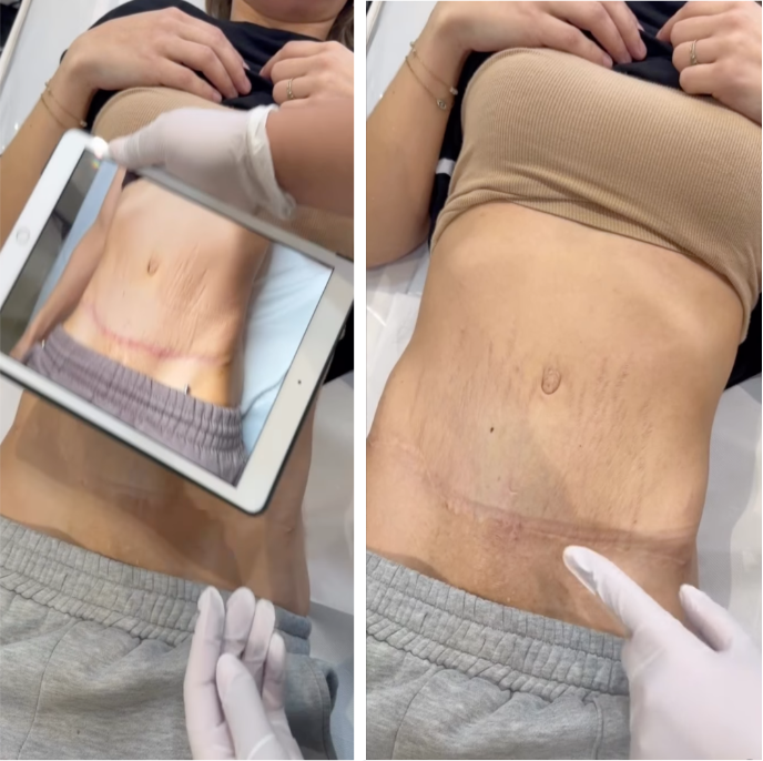 Cicatrice de césarienne : avant et après le protocole